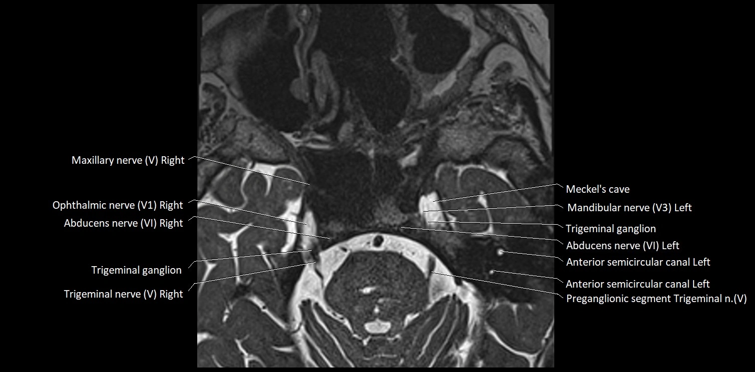 Cranial nerve anatomy axial MRI 3T image 42.webp